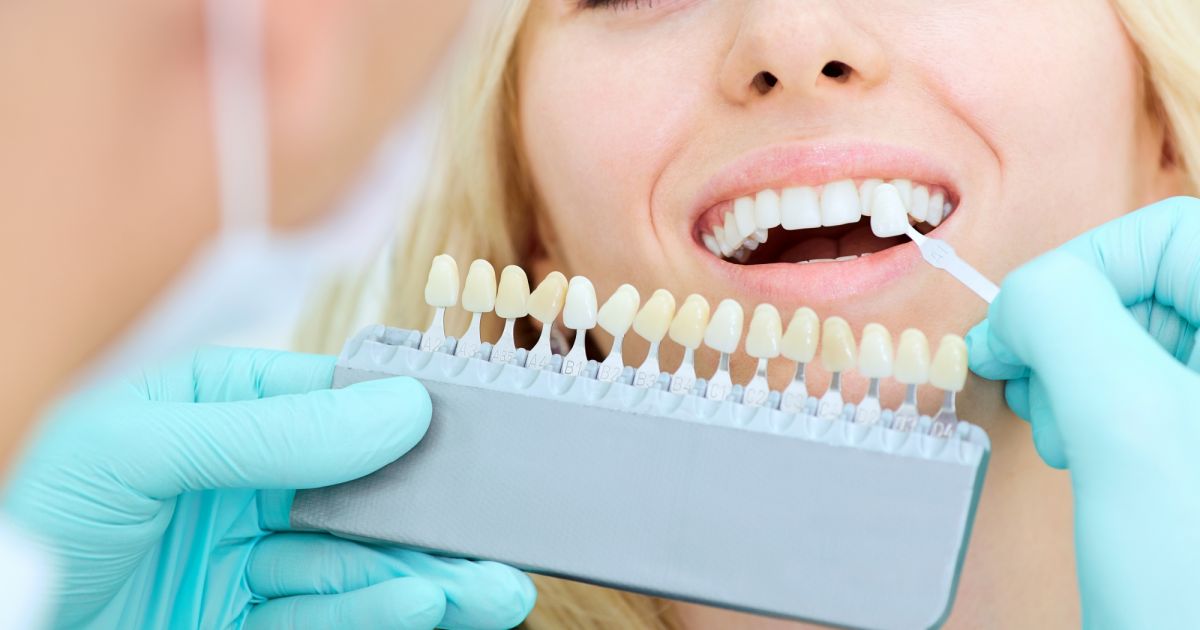 Existem dúvidas entre faceta dentária e lentes de contato